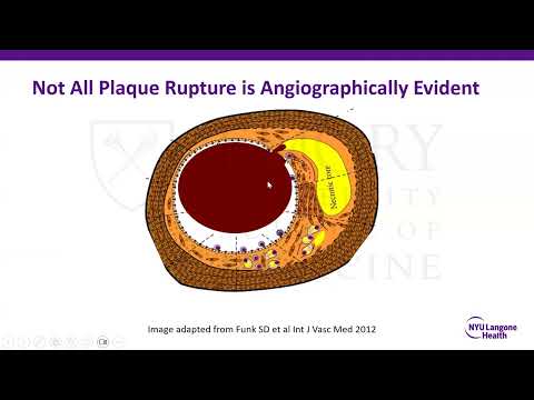 Update on Myocardial Infarction with Non-Obstructive CAD (MINCOA)
