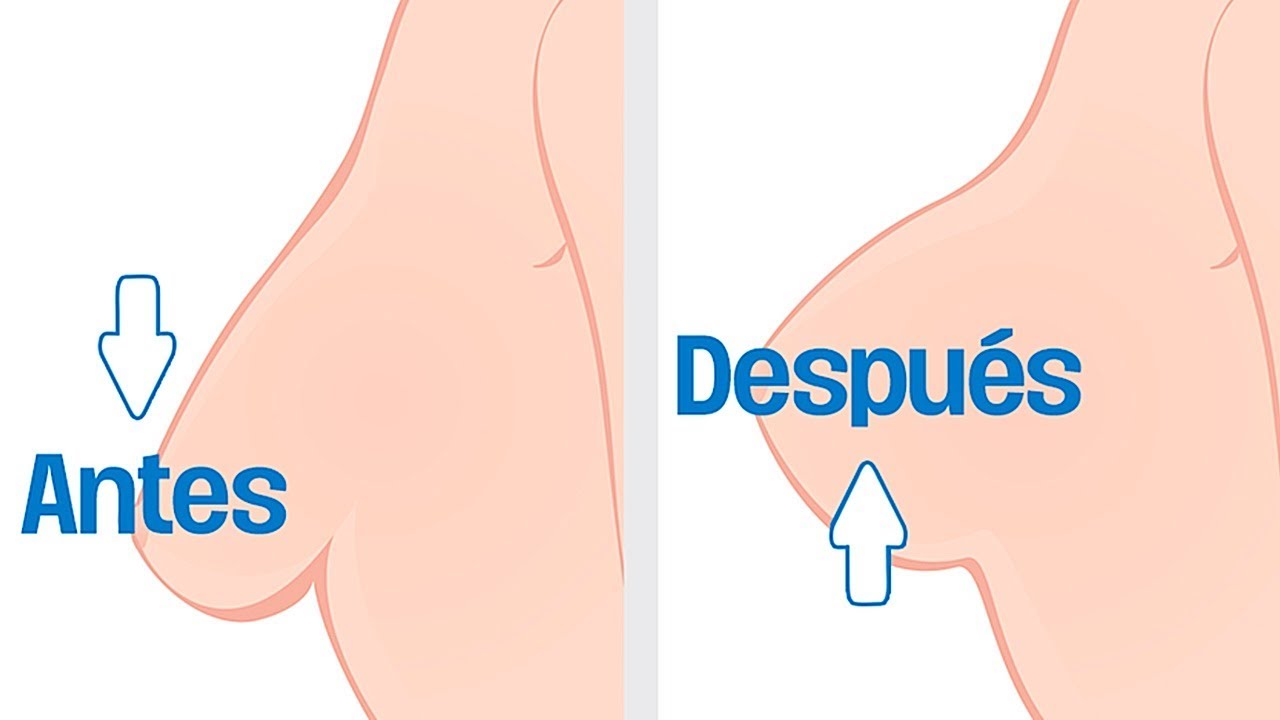 COMO REAFIRMAR LOS SENOS CAÍDOS | ESTO FUE LO QUE HICE!