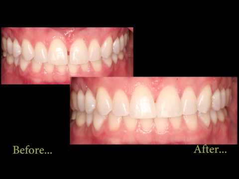 Teeth Bonding | Thousand Oaks Cosmetic Dentistry