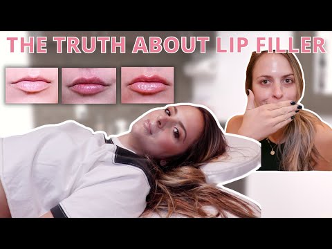 FIRST TIME GETTING LIP FILLER: entire process & healing journey| natural looking lip filler?