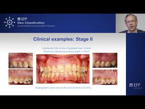 Assessing Periodontitis: Clinical Examples & Key Points