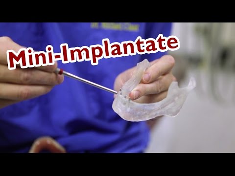 Was sind eigentlich Mini-Implantate?