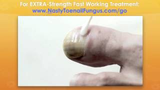 Have White Toenail Fungus? Here's How To Remove White Nail Fungus Fast