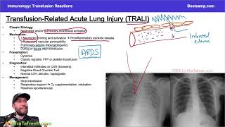 Download lagu Transfusion-Related Acute Lung Injury (TRALI) || immunology .   #immunology #usmlestep1videos  mp3