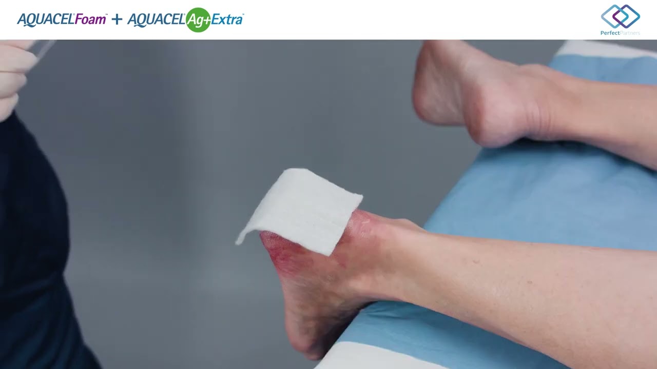Watch Aplicación de AQUACEL Foam + AQUACEL Ag+ Extra en úlcera de talón Now Aplicación de AQUACEL Foam + AQUACEL Ag+ Extra en úlcera de talón