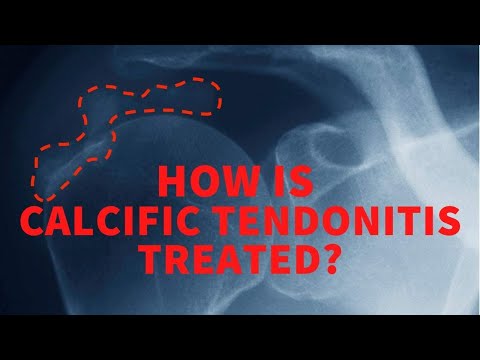 How is calcific tendonitis treated?