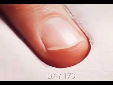 Fingernail growth timelapse