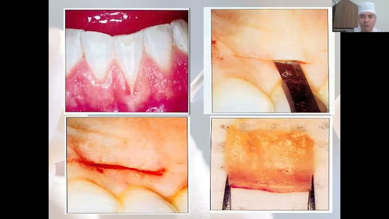 Paradontal xirurgiyaga kirish. Paradont kasalliklarni xirurgik davolash usullariga ko`rsatmalar.