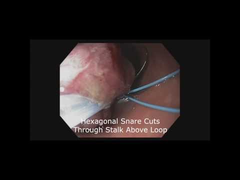 Usunięcie uszypułowanego polipa pętlą endoskopową
