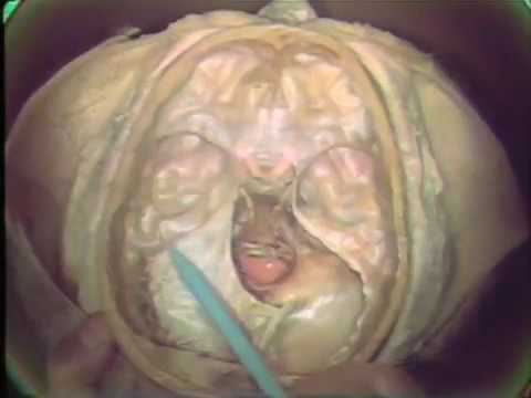 Cranial Meninges, Dural Venous Sinuses and Cerebrospinal Fluid