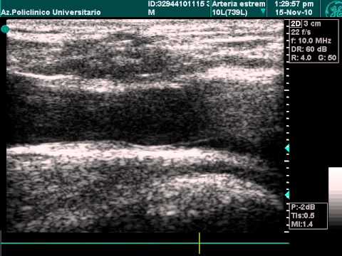 Common Femoral Vein Valve In Doppler Examination