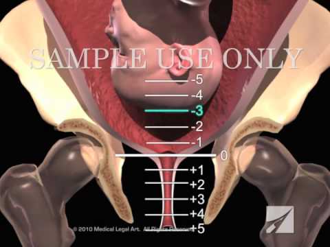 Birth Stations of Presentation (-5 to +5 Positions)