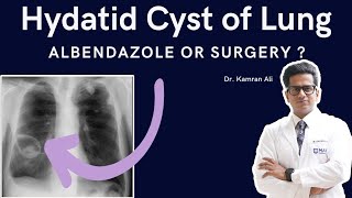 Hydatid Cyst Lung: Symptoms, CT Signs, Albendazole vs VATS Surgery | Dr Kamran Ali (India)