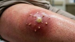 Multiloculated abscess drainage tutorial