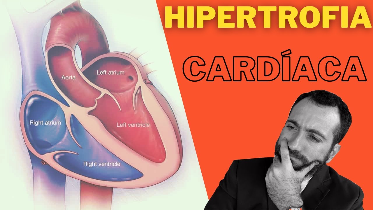 Hipertrofia cardíaca