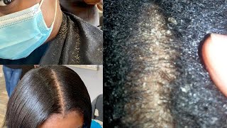 Dry Flaky Scalp Treatment For Relaxed Hair
