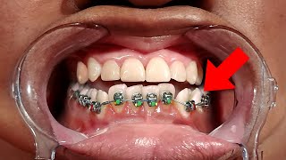 Can I only Get BRACES on my Bottom Teeth?... Orthodontist explains