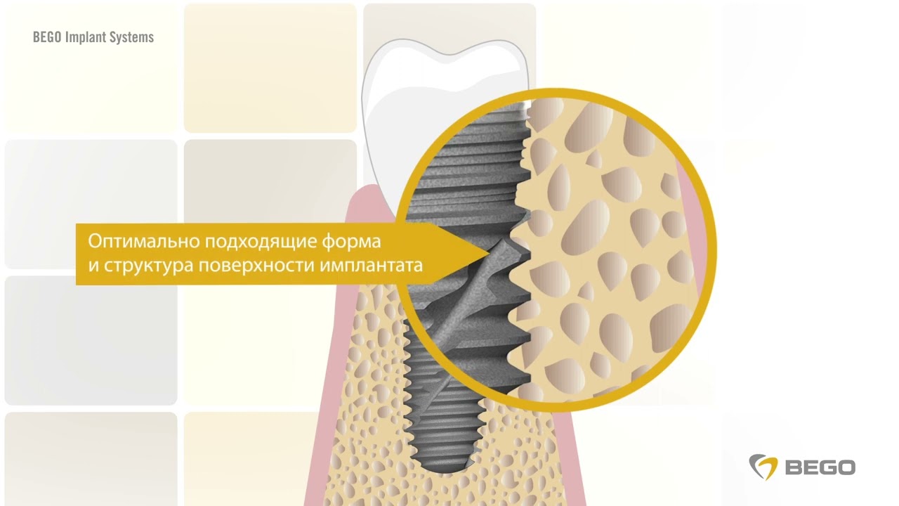 BEGO Implant Systems - animacja dla pacjentów (język rosyjski)