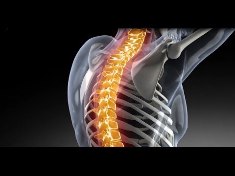 Ограничение при сколиозе 2 степени Какой рентген при сколиозе