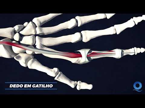Dedo em gatilho | Quialheiro Medicina Avançada