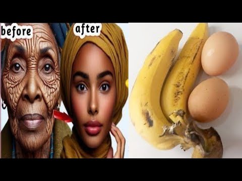 Remove Wrinkles From Face Naturally at Home / Get Rid of Deep Mouth Wrinkles using Banana and Egg