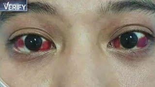 Verify: Can gaming cause blood vessels in your eyes to burst?