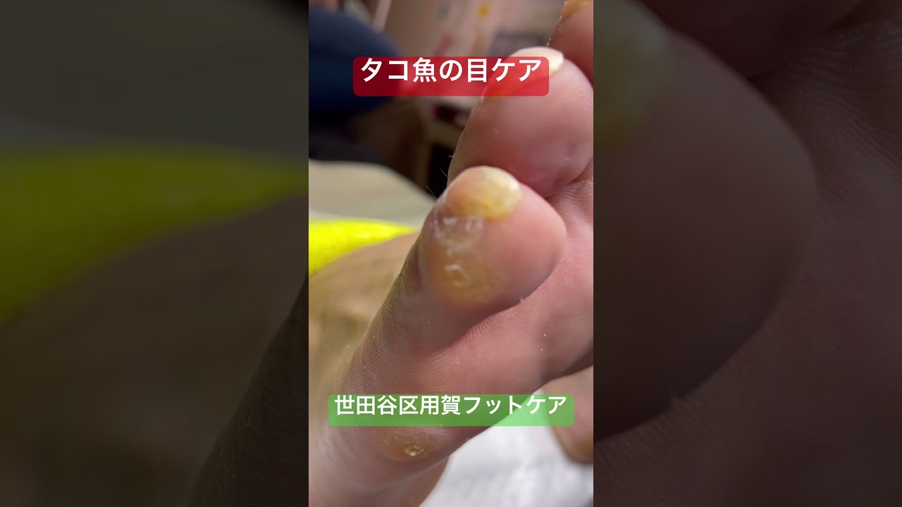 タコ魚の目ケア