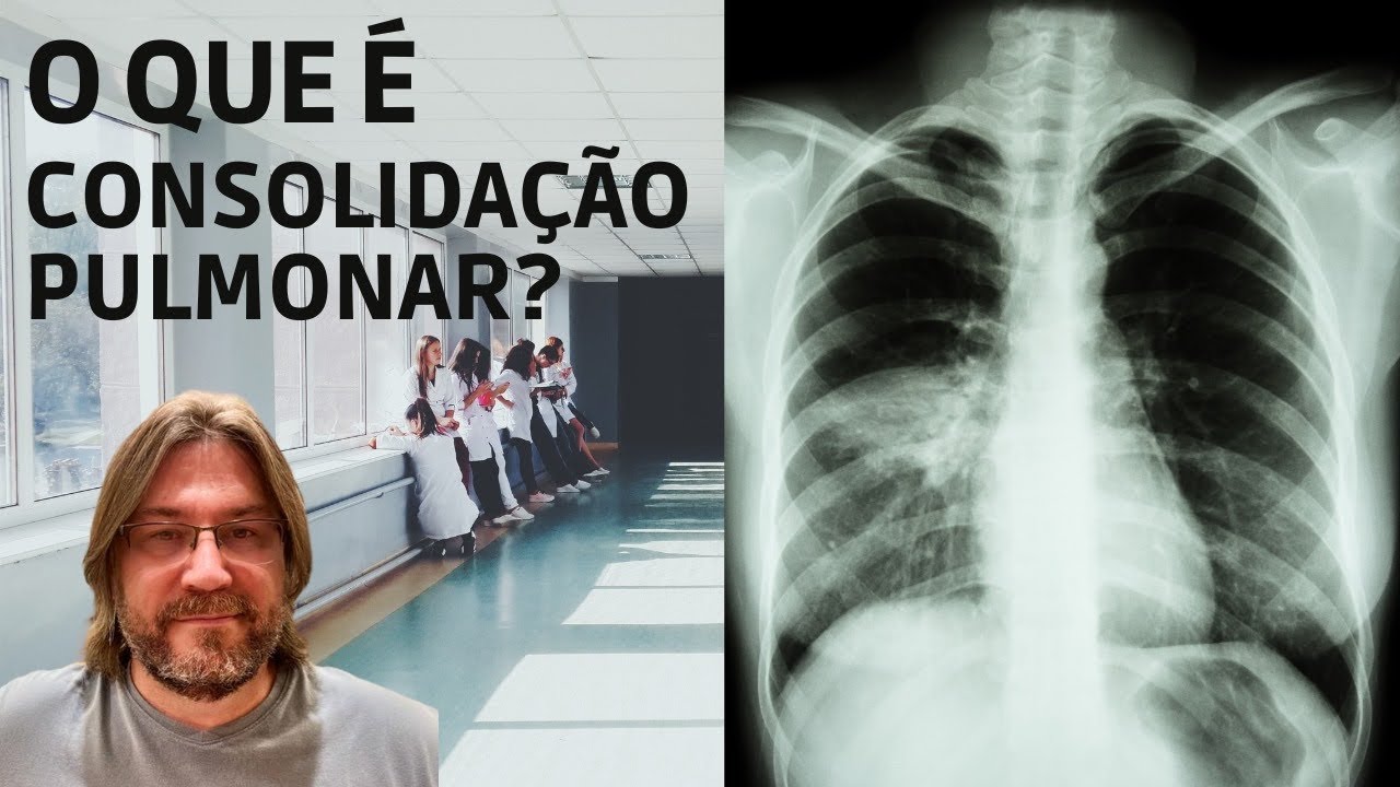 Você sabe o que é consolidação pulmonar?