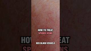 How to treat spider veins and broken capillaries?