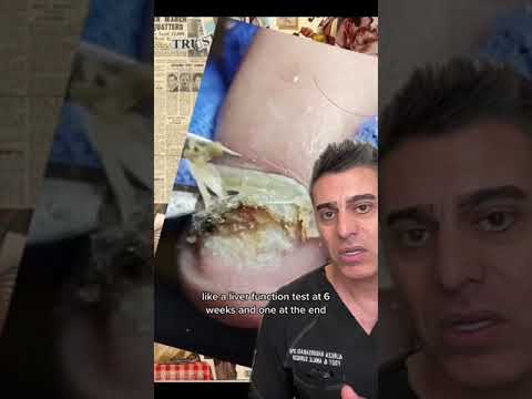 Fungal Toenail Explained By Dr. Khosroabadi