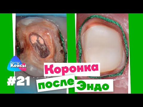 Коронка после Эндо | Дентал Кейсы от BG #21