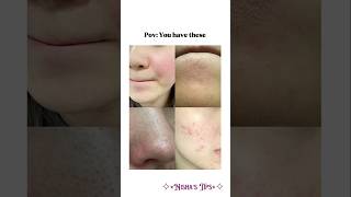 Pimples? Pigmentation? Pores? Blackheads? Tiny bumps?🎀 #shorts #aesthetic #skincare #fyp #glowuptips