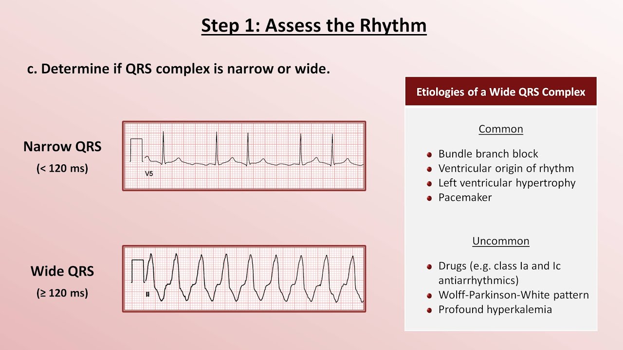 Intro to EKG Interpretation - A Systematic Approach