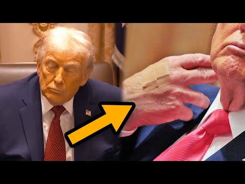 Trump is yellow, covered in bruises and bandaids