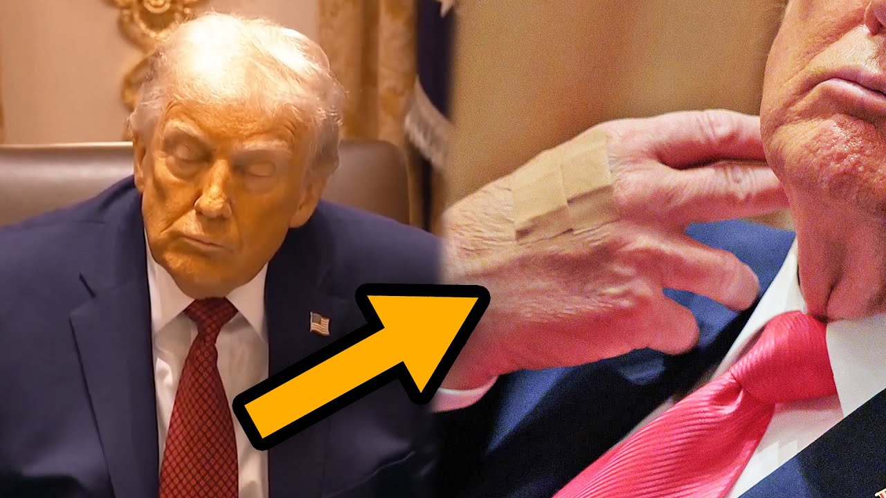 Trump is yellow, covered in bruises and bandaids