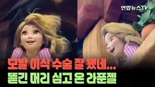 모발 모발~ 이식 수술하고 왔습니다…까마귀한테 뜯긴 머리 심고 온 라푼젤 [세상에이런뉴스] / 연합뉴스TV (YonhapnewsTV)