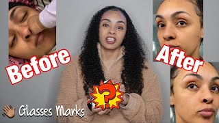 REMOVE GLASSES MARKS IN 3 DAYS | 1 INGREDIENT!