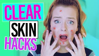 GET RID OF ACNE OVERNIGHT! Life Hacks for Clear Skin