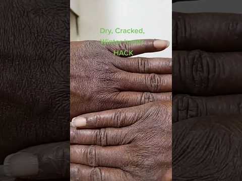 DRY CRACKED HANDS REMEDY #dryhands #cracked #softskin #naturalremedies