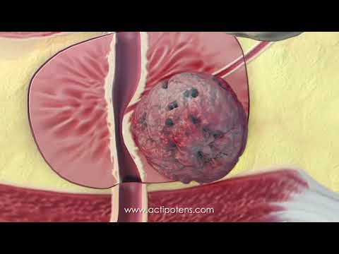 Puchit Bauch mit Prostatitis Wenn die Behandlung von Prostatitis zu starten