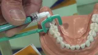 Filling cavities without drilling | North County | San Diego