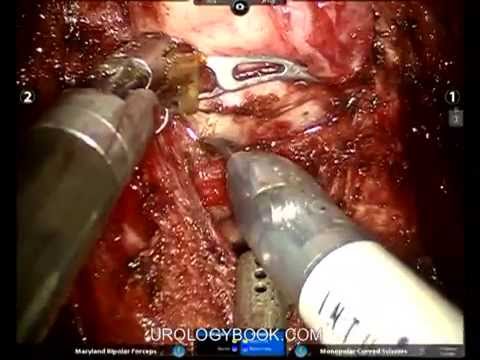 Robotic Assisted Laparoscopic Radical Prostatectomy