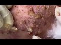 Blackheads & Milia, Big Cystic Acne Blackheads Extraction Whiteheads Removal Pimple Popping [EP3]