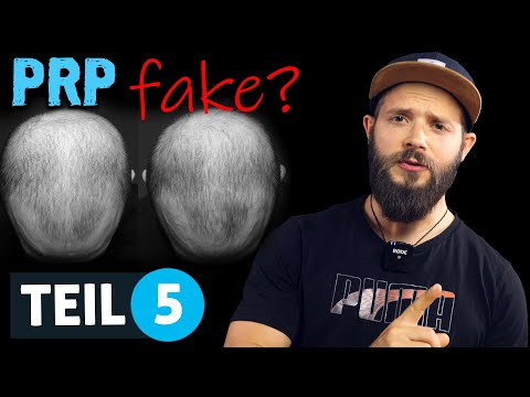 PRP for hair loss: FAKE or EFFECTIVE? | PRP Treatment Part 5