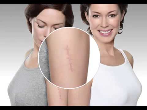 Отзыв о Набор для коррекции растяжек "Ферменкол" Однозначно рекомендую!