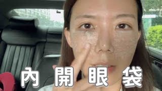 內開眼袋+淚溝回填分享、台灣的醫美技術不要太好了吧!