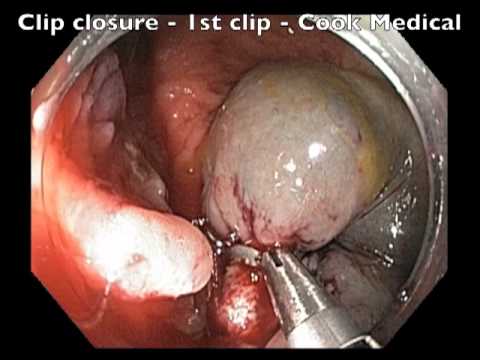 Cecum - Resection of Large Pedunculated Polyp