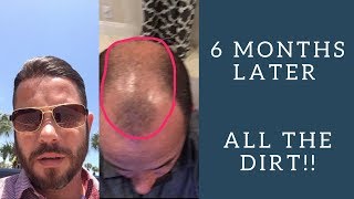 Hair replacement Men's Hair System Review 6 Months Later All the Dirt!