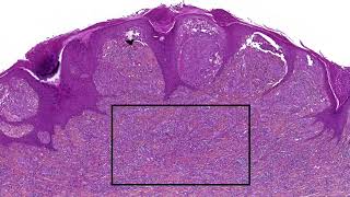 ALK-fused plexiform Spitz nevus: rotating video clip of cases in the #NonAIpath program