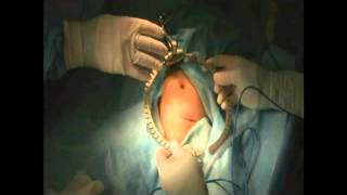Mini Bookler in Pediatric Urology
